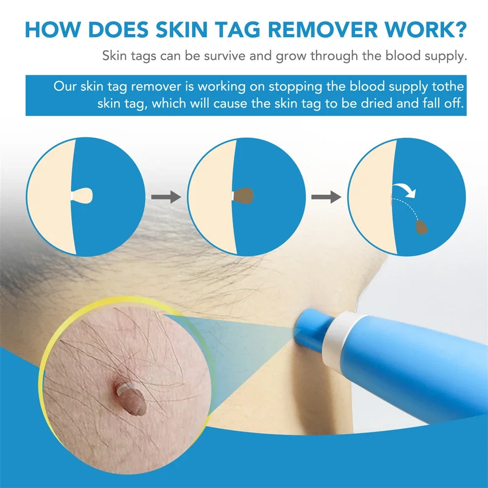 2-in-1 Skin Tag & Mole Remover Kit