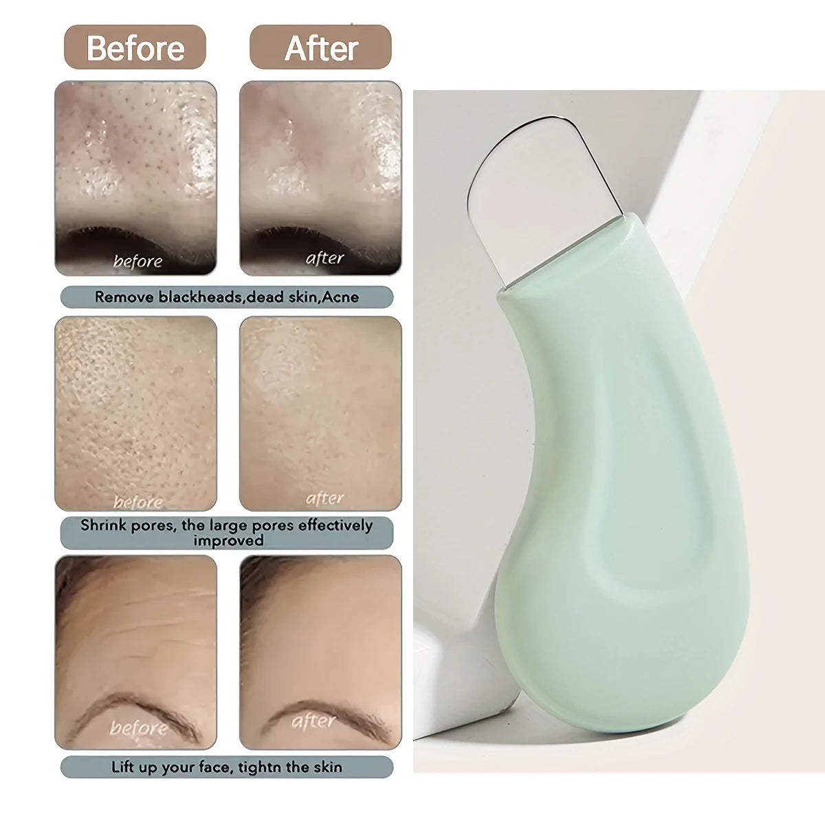 Facial Blackhead Removal